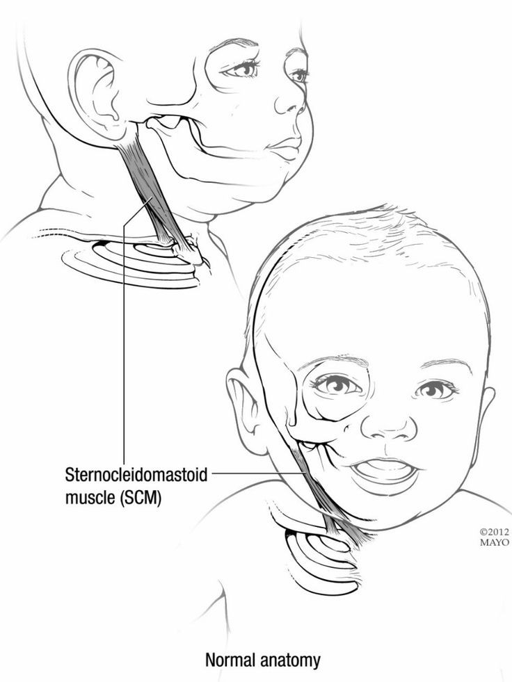 Kreivakaklystė - Image 2